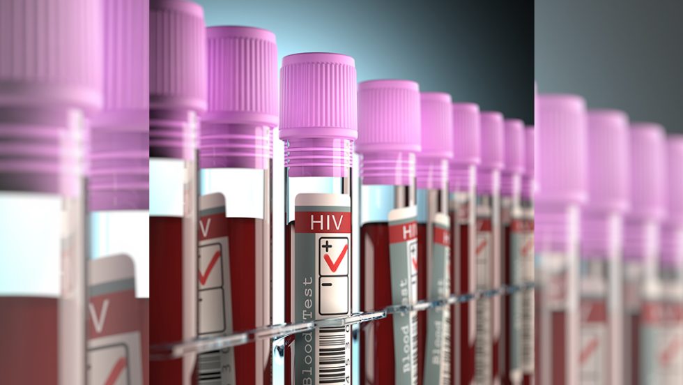hiv aids